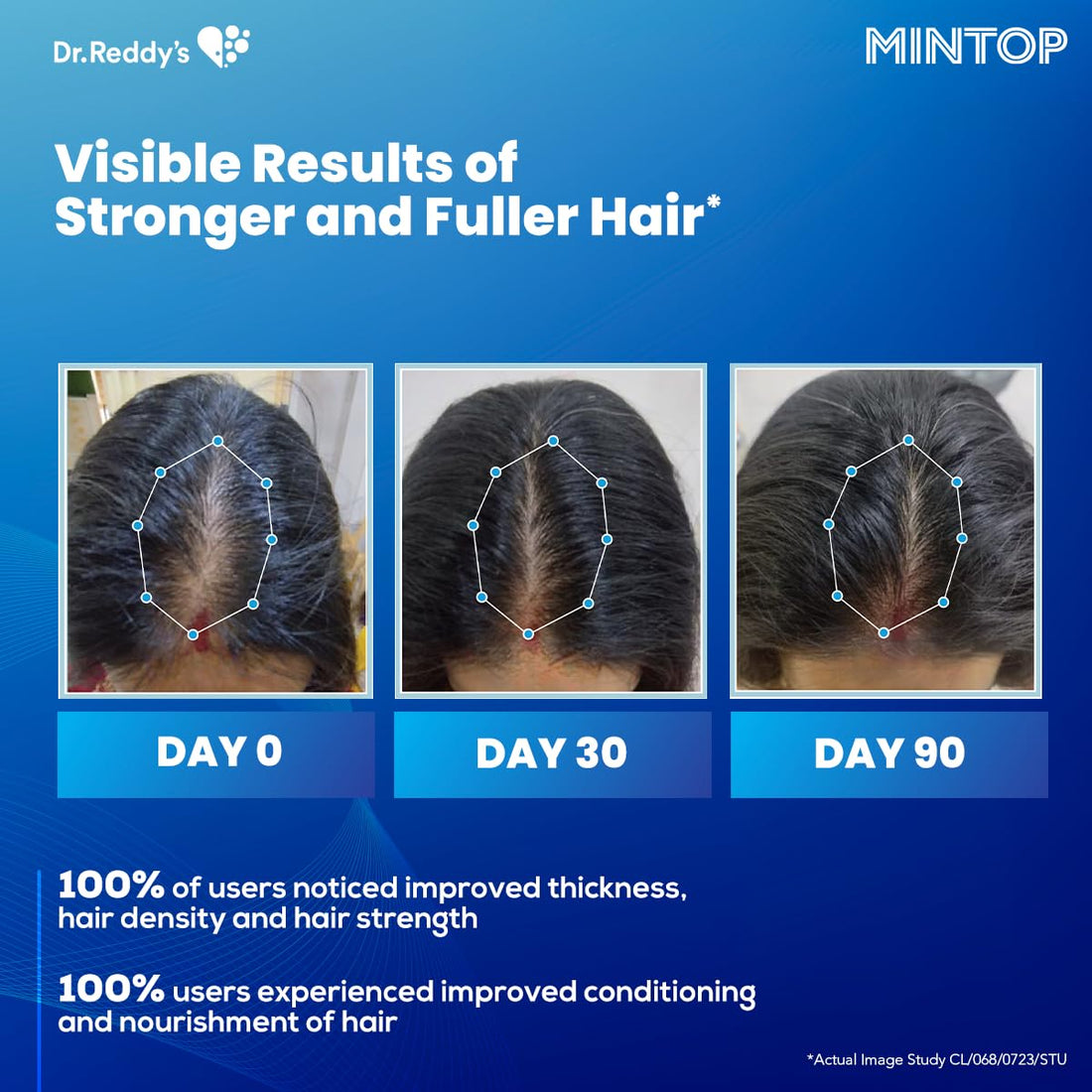 Dr. Reddy’s Hair Care: Advancing Hair Regrowth Solutions with Mintop