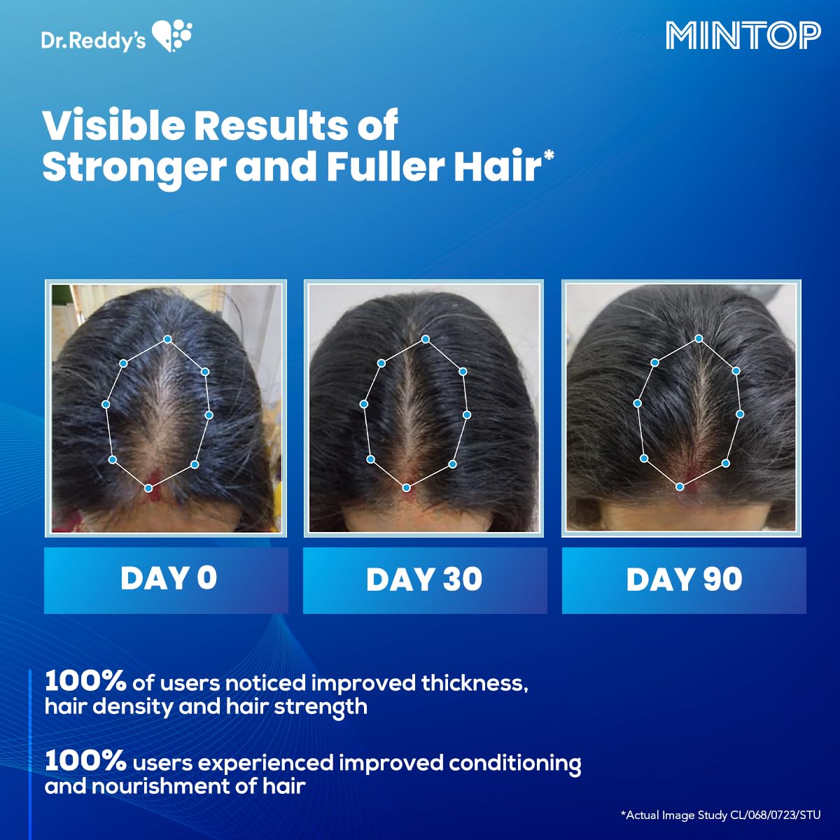 Dr. Reddy’s Hair Care: Advancing Hair Regrowth Solutions with Mintop